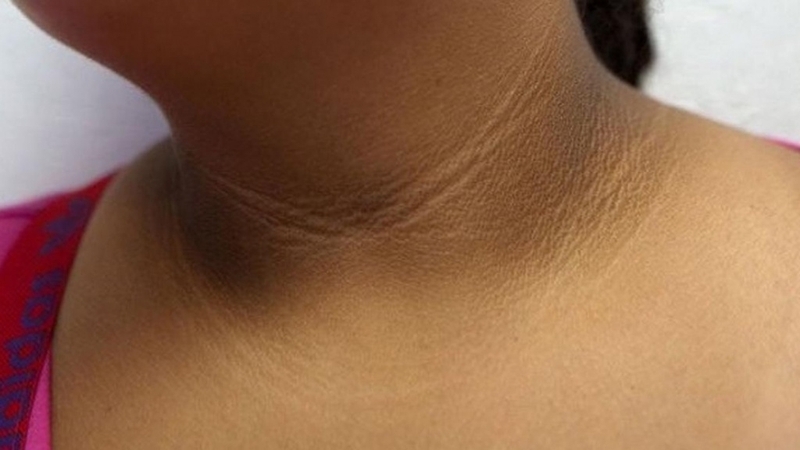 Trẻ bị bệnh gai đen: Nguyên nhân, triệu chứng và cách điều trị 3