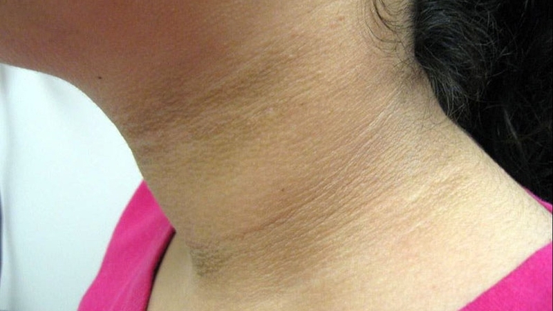 Trẻ bị bệnh gai đen: Nguyên nhân, triệu chứng và cách điều trị 2