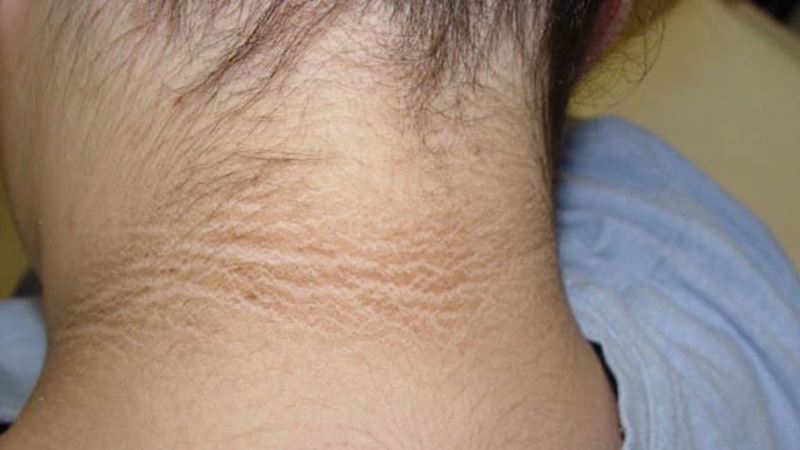 Trẻ bị bệnh gai đen: Nguyên nhân, triệu chứng và cách điều trị 1