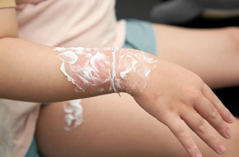Trẻ bị bỏng bôi thuốc gì? Nên làm gì khi trẻ bị bỏng 1