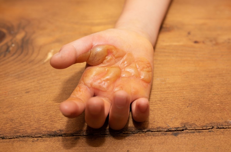 Trẻ bị bỏng bôi thuốc gì? Nên làm gì khi trẻ bị bỏng 3