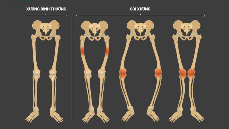 Trẻ bị còi xương nên bổ sung gì? 2