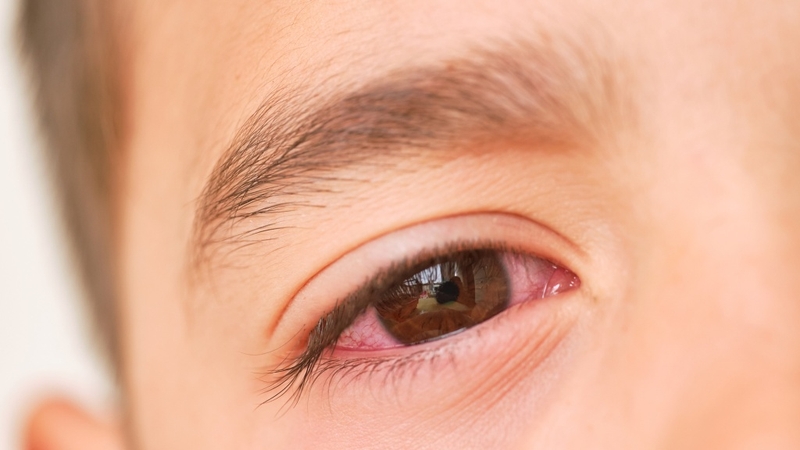 Trẻ bị đau mắt đỏ kèm sốt và những điều bố mẹ cần biết 1