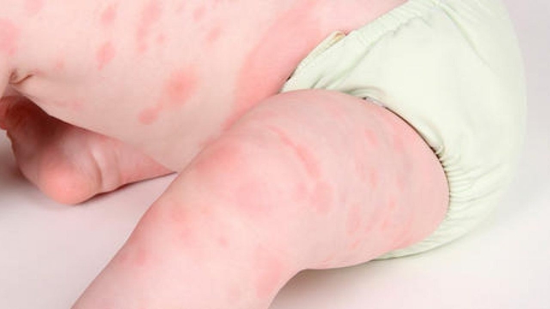 Nhiều trẻ bị dị ứng thời tiết vào thời điểm chuyển mùa