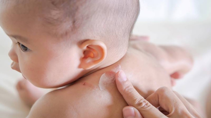 Thoa kem dưỡng ẩm giúp bé giảm ngứa ngáy