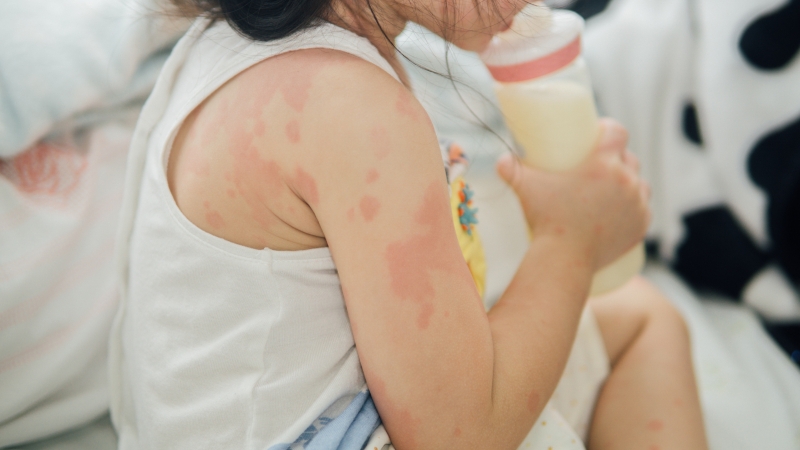 Trẻ bị dị ứng thức ăn có nguy hiểm không?