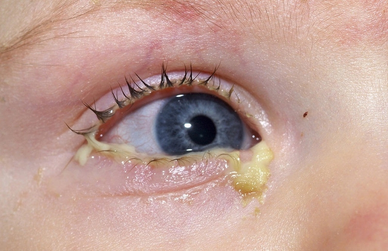 Trẻ bị đổ ghèn mắt và chảy nước mũi​: Nguyên nhân và cách điều trị 1