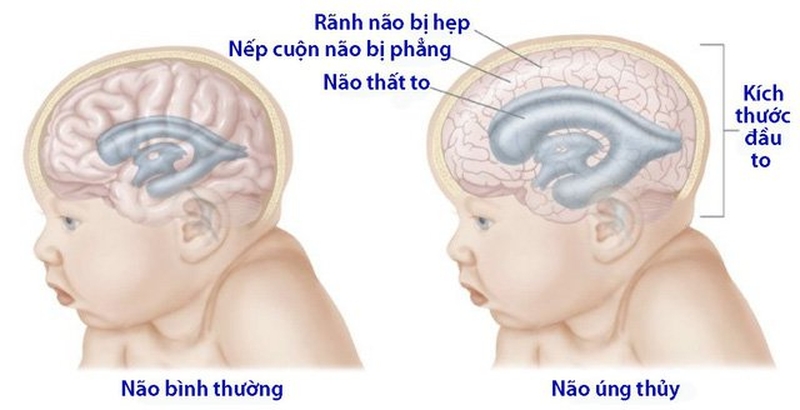 Trẻ bị não úng thủy sống được bao lâu? Nguyên nhân, triệu chứng và cách điều trị 1