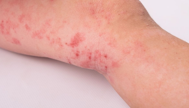 Trẻ bị nổi mẩn đỏ ở chân​ là bệnh gì? Cách điều trị ra sao 1