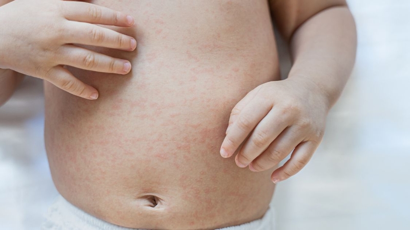 Trẻ bị phát ban có nằm quạt được không? Cách nằm quạt an toàn 1