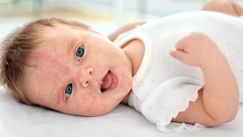 Trẻ bị phát ban có nằm quạt được không? Cách nằm quạt an toàn 4