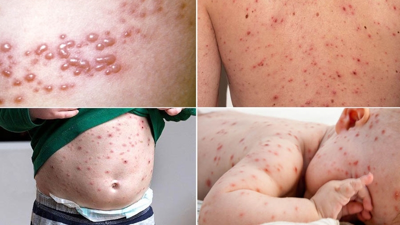 Trẻ bị phỏng dạ: Nguyên nhân, triệu chứng và cách điều trị hiệu quả 2