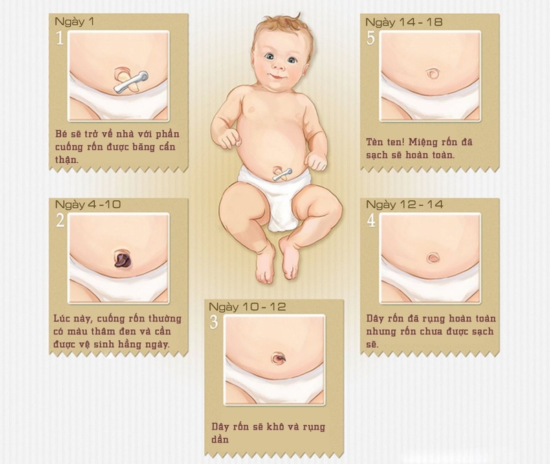 Trẻ bị rốn lồi có thể tự khỏi không 1