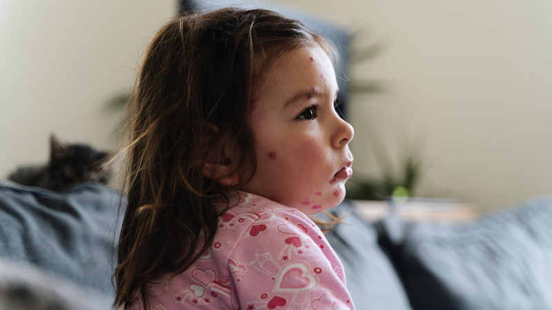 Trẻ bị sởi kiêng gì? Những lưu ý khi chăm sóc cho trẻ bị sởi 2