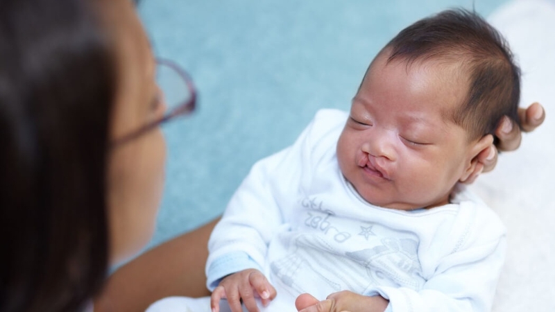 Trẻ bị sứt môi 4mm phải khắc phục như thế nào? 1