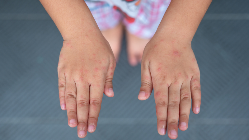 Trẻ bị tay chân miệng không phải lúc nào cũng cần uống Oresol