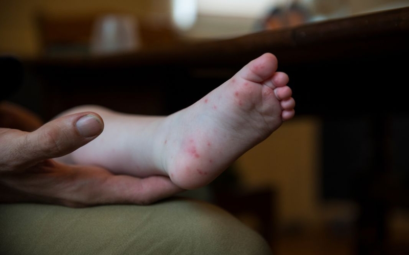 Trẻ bị tay chân miệng có lây cho người lớn không 4