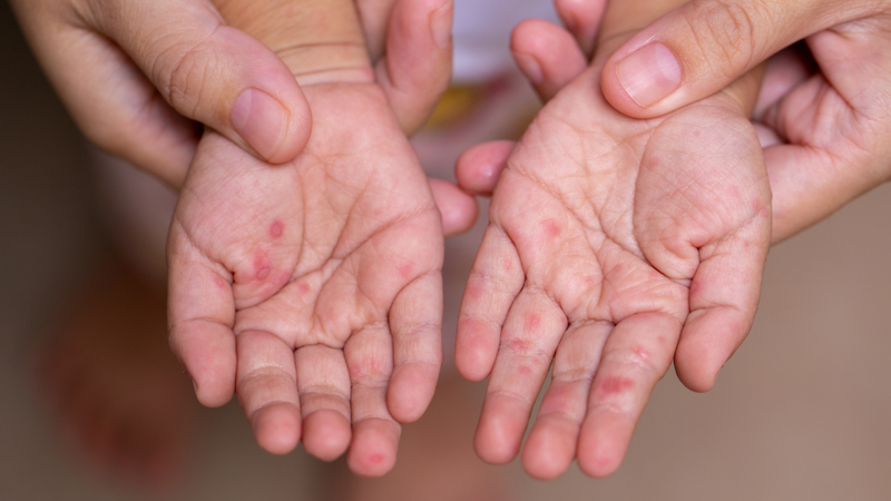 Virus tay chân miệng tồn tại lâu trong môi trường, dễ lây lan nếu không vệ sinh đúng cách