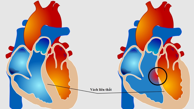 Trẻ bị thông liên thất có tiêm phòng được không? 1