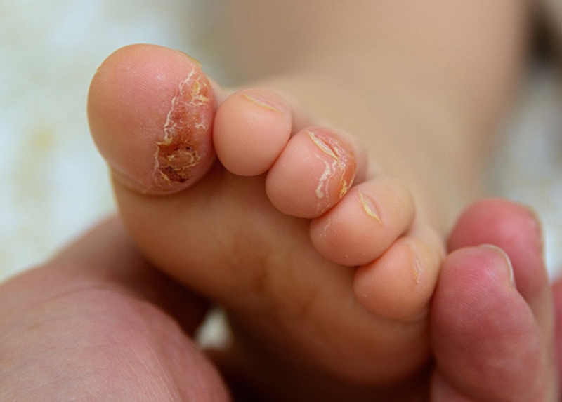 Trẻ bị tróc da đầu ngón tay thiếu chất gì? Xử lý như thế nào? 4