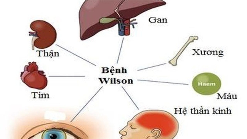 Trẻ bị Wilson nên bổ sung những chất dinh dưỡng nào 3
