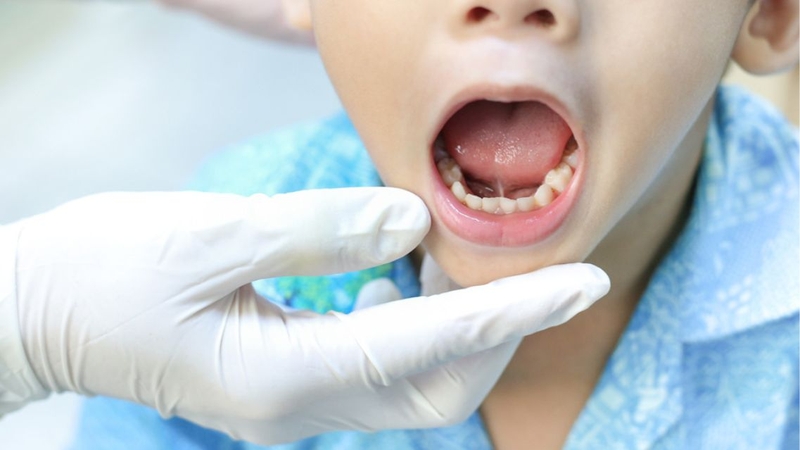 Trẻ có thể đau và khó chịu nhẹ sau cắt thắng lưỡi