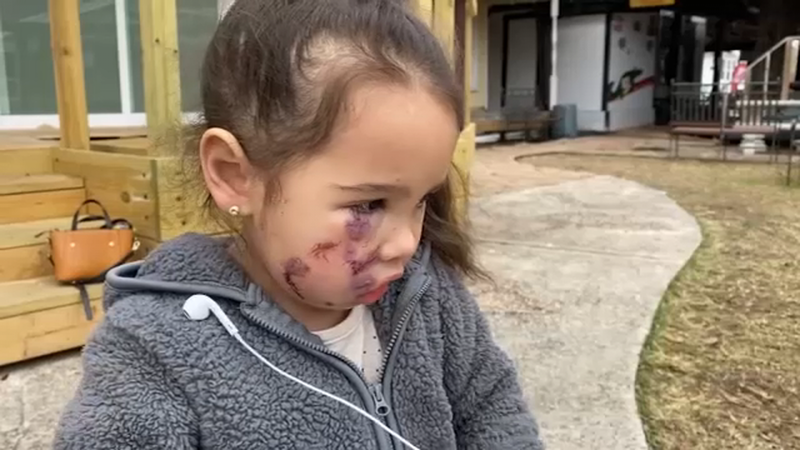 trẻ em bị chó cắn phải làm sao 1