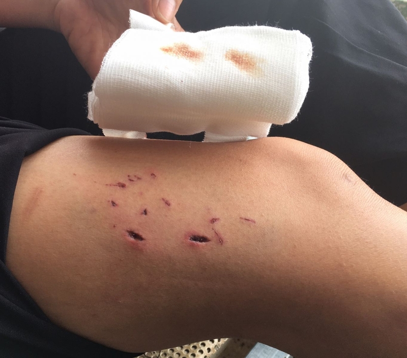 trẻ em bị chó cắn phải làm sao 3