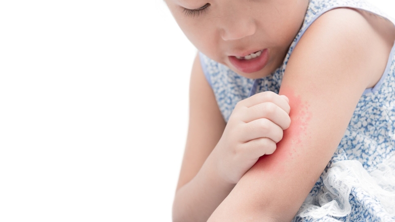 Trẻ em bị nổi mẩn đỏ ngứa khắp người do đâu? Cách điều trị và phòng ngừa 1