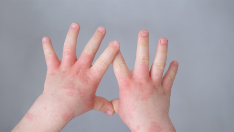 Trẻ em bị nổi mẩn đỏ ngứa khắp người do đâu? Cách điều trị và phòng ngừa 2
