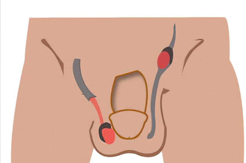 Tinh hoàn ẩn ở trẻ em liệu có nguy hiểm?-1