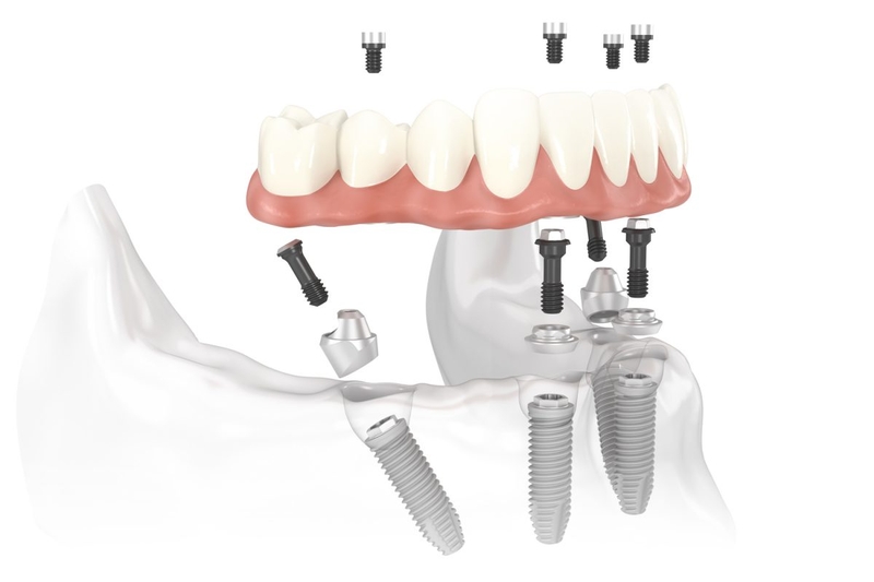 Trẻ em có trồng răng implant được không? Những lưu ý khi trẻ bị mất răng 3
