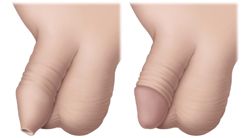 Trẻ em nên dùng thuốc bôi hẹp bao quy đầu nào? 1