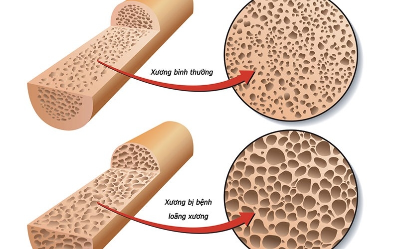 Trẻ em và bà bầu uống canxi có bị táo bón không?