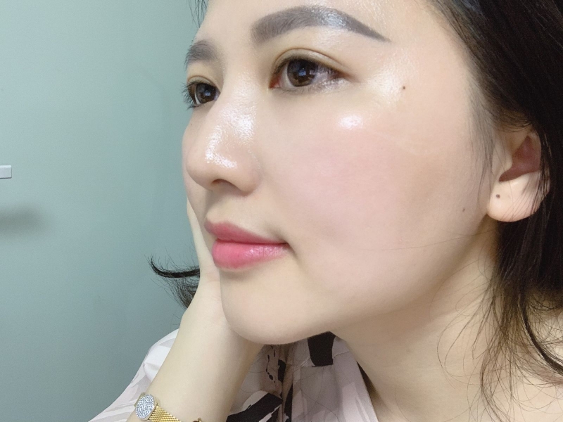 Trẻ hóa da bằng phương pháp cấy collagen tươi có tốt không