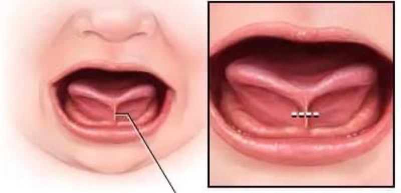 Trẻ lưỡi ngắn khó phát âm nên điều trị như thế nào? -1