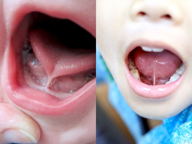 Trẻ lưỡi ngắn khó phát âm nên điều trị như thế nào? -2