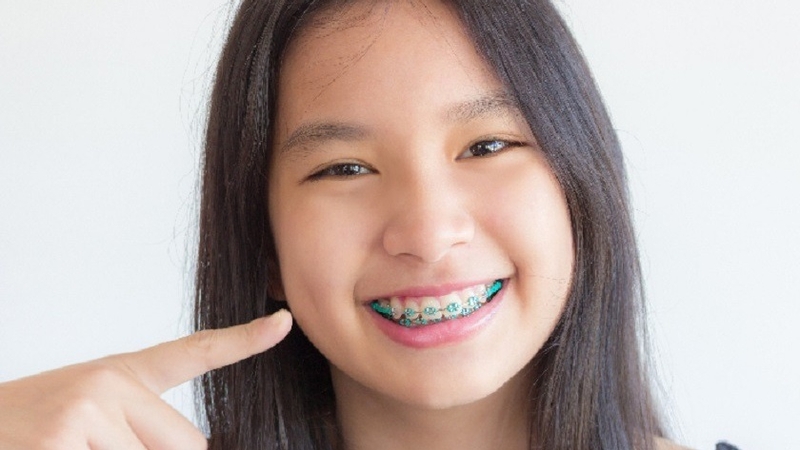 Trẻ mấy tuổi có thể niềng răng? 2