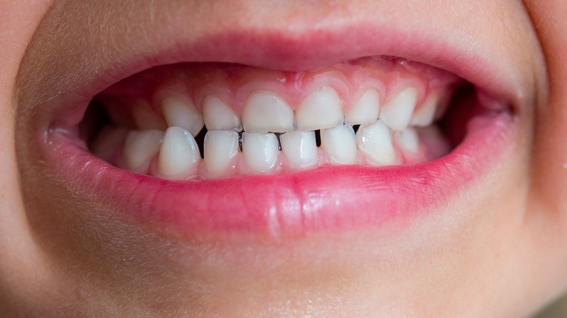 Trẻ từ 3 - 6 tuổi nên đánh răng đều đặn vào mỗi tối và sáng