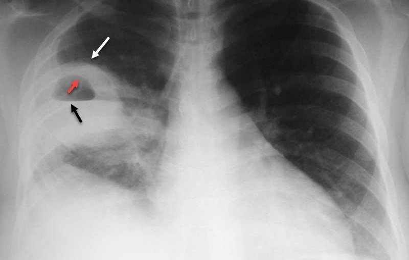 Trẻ nhiễm virus hợp bào hô hấp đang gia tăng2
