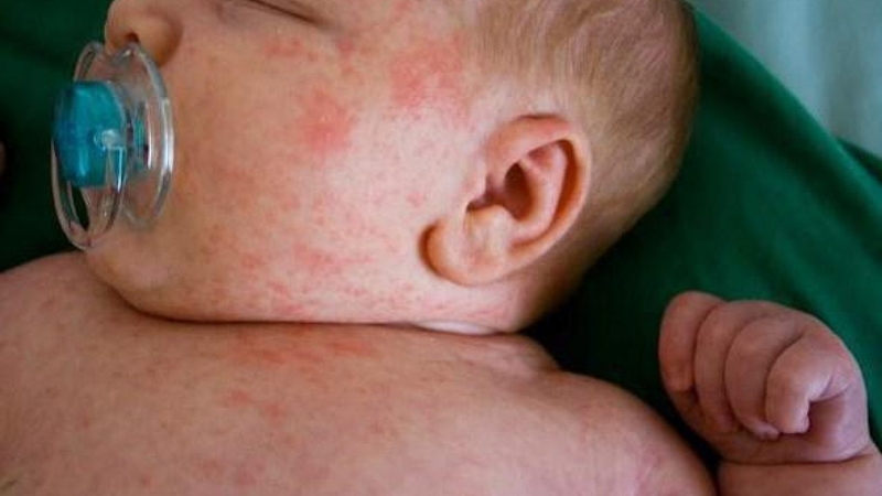 Rôm sảy thường xảy ra ở trẻ nhỏ vào mùa hè, thời tiết nắng nóng