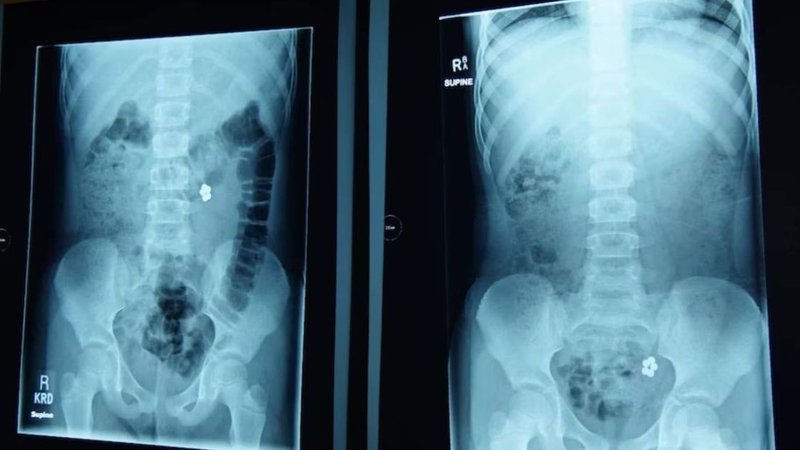 Trẻ nuốt phải viên bi có sao không? Cách xử lý khi trẻ nuốt phải bi 4