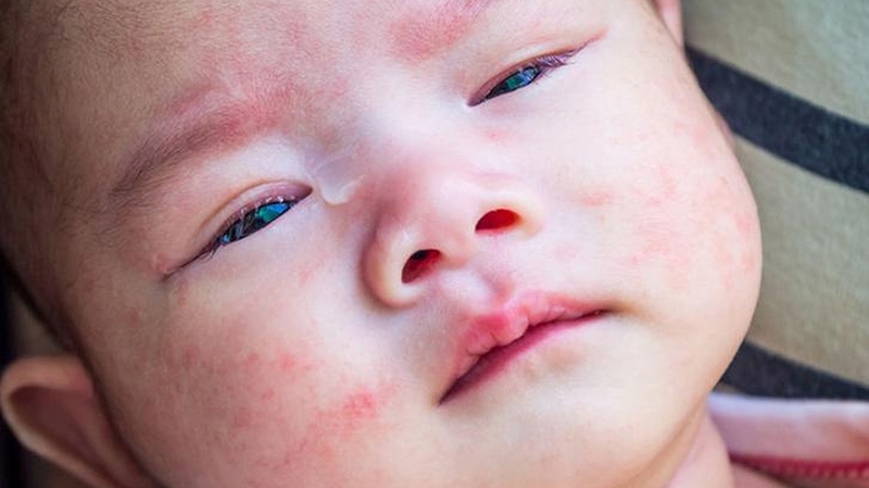 Trẻ phát ban đỏ sau 3 ngày sốt: Nguyên nhân và biện pháp xử lý 1