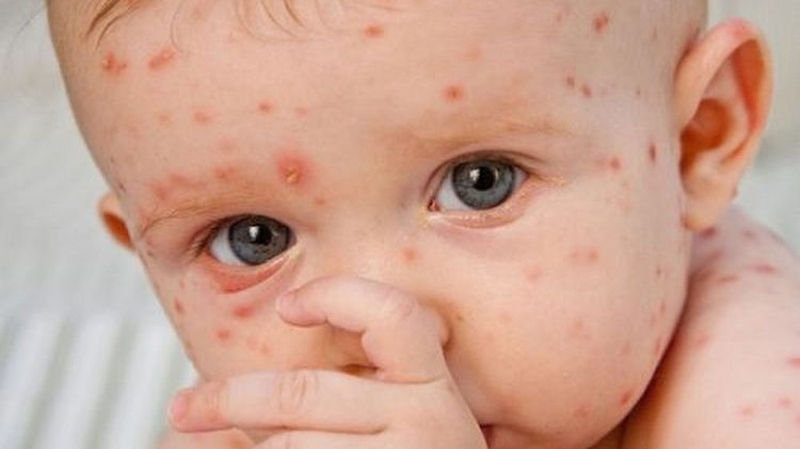 Trẻ phát ban đỏ sau 3 ngày sốt: Nguyên nhân và biện pháp xử lý 2