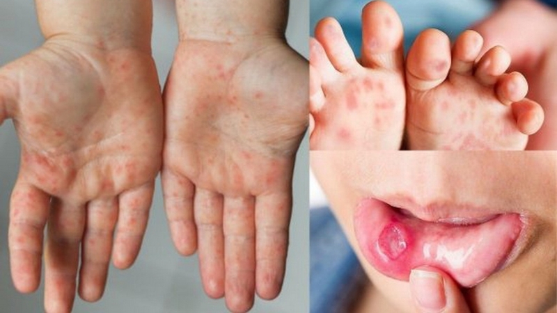 Trẻ phát ban đỏ sau 3 ngày sốt: Nguyên nhân và biện pháp xử lý 3