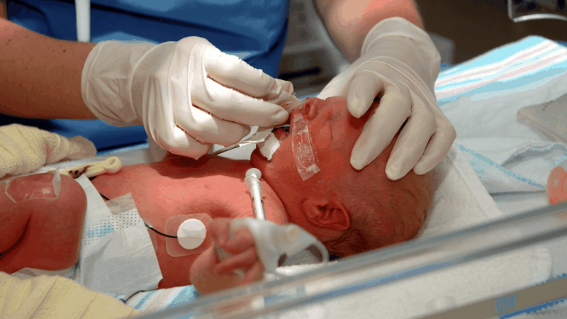 Trẻ sinh non 26 tuần có nuôi được không? 1