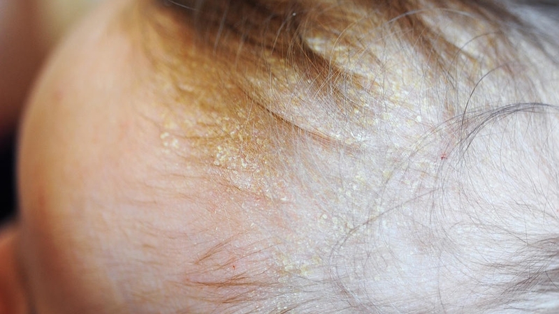 Trẻ sơ sinh bị gàu: Nguyên nhân và cách khắc phục 1