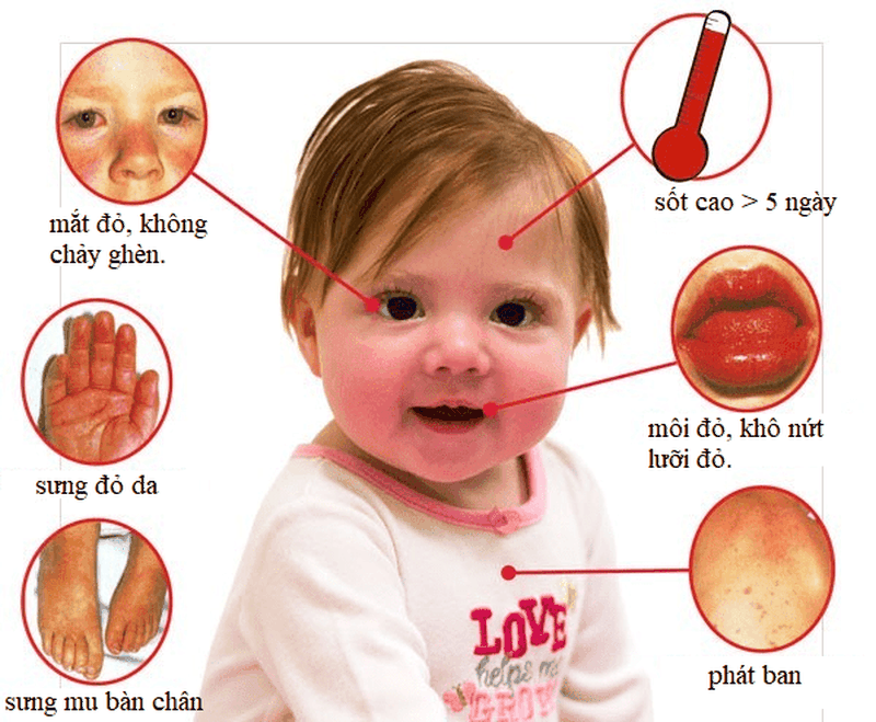 Trẻ sơ sinh bị khô môi báo hiệu điều gì? 3