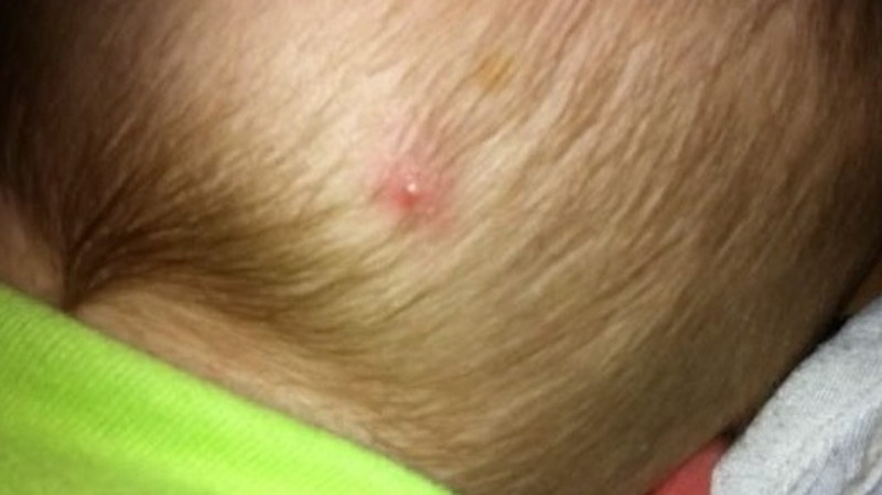 trẻ sơ sinh bị mụn nhọt ở đầu