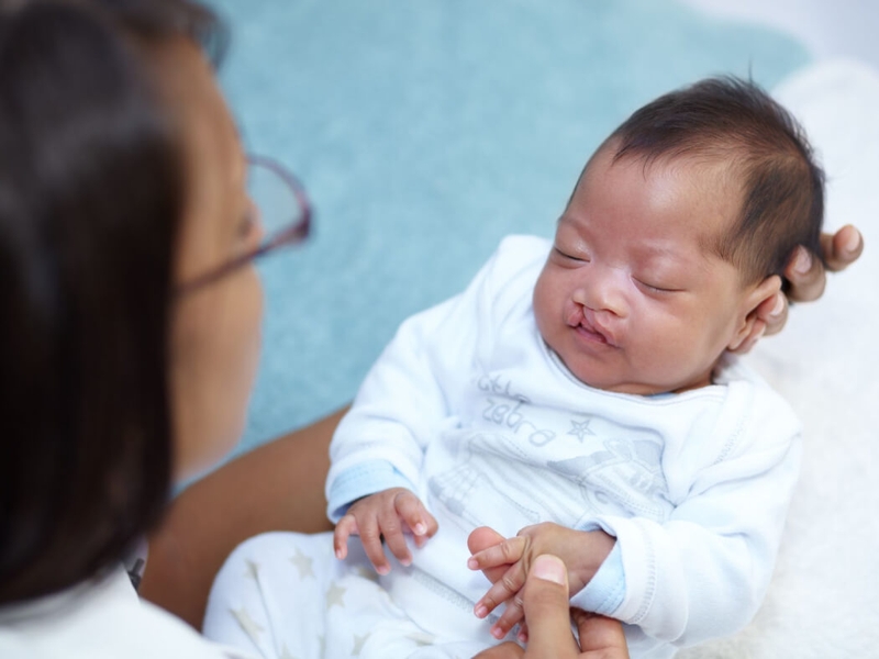 Trẻ sơ sinh bị sứt môi nhẹ có phẫu thuật không? Nguyên nhân gây sứt môi hở hàm ếch 4